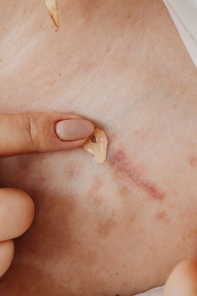 Person applying concealer on skin scar with manicured nail.