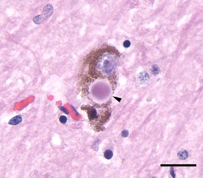 Lewy bodies