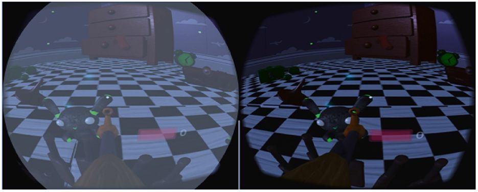 amblyopia (lazy eye) vision impairment