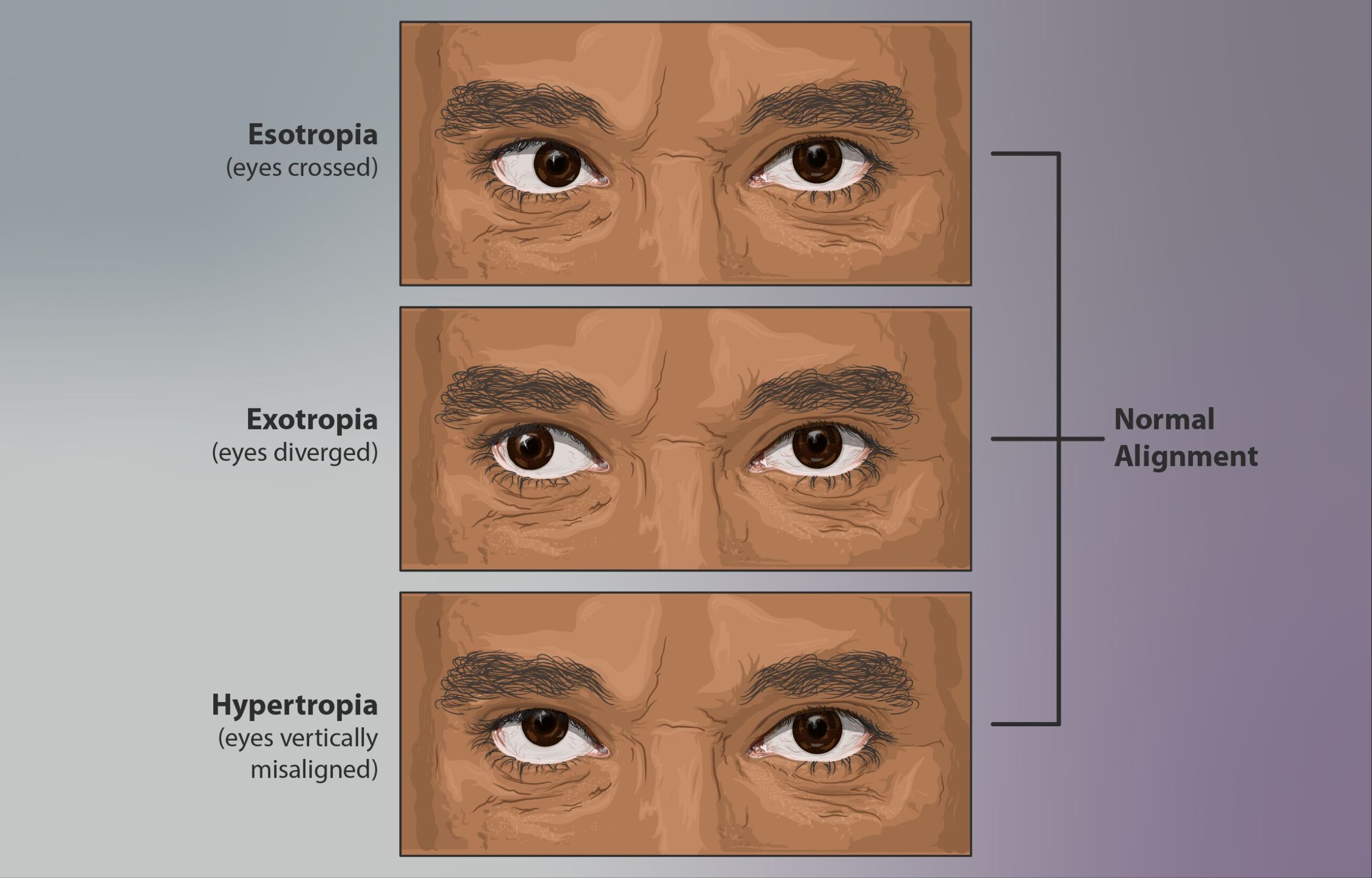 cross-eyed strabismus