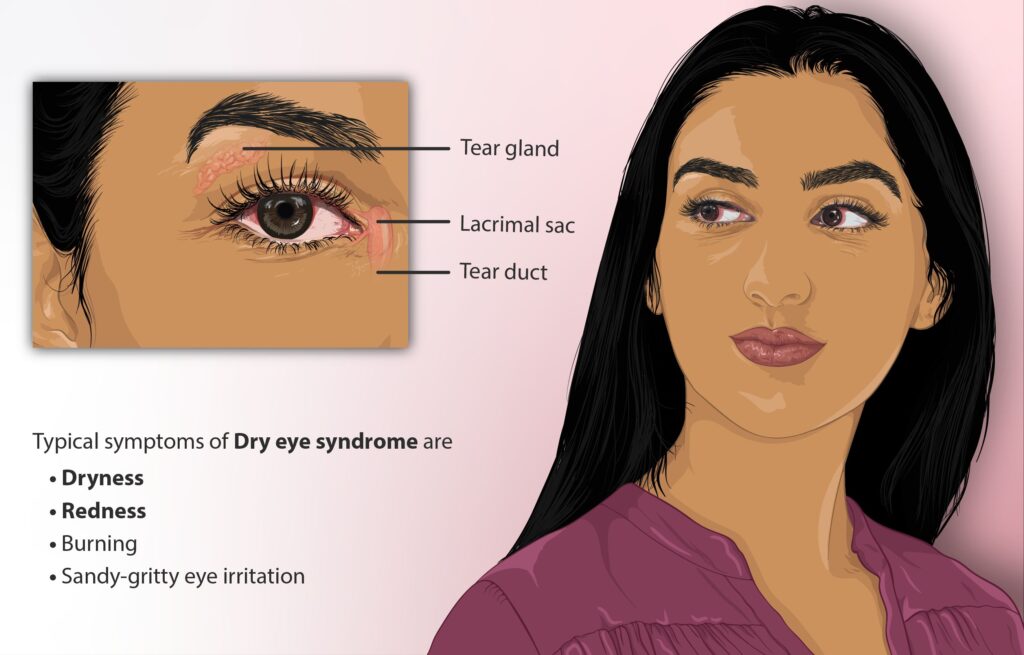 dry eye syndrome screen time