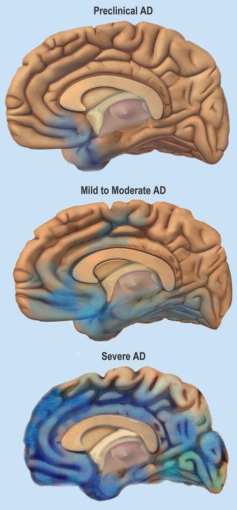 Declining Health and Alzheimer's Diagnosis
