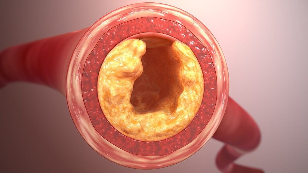 Understanding LDL vs. Dietary Cholesterol: A Crucial Distinction