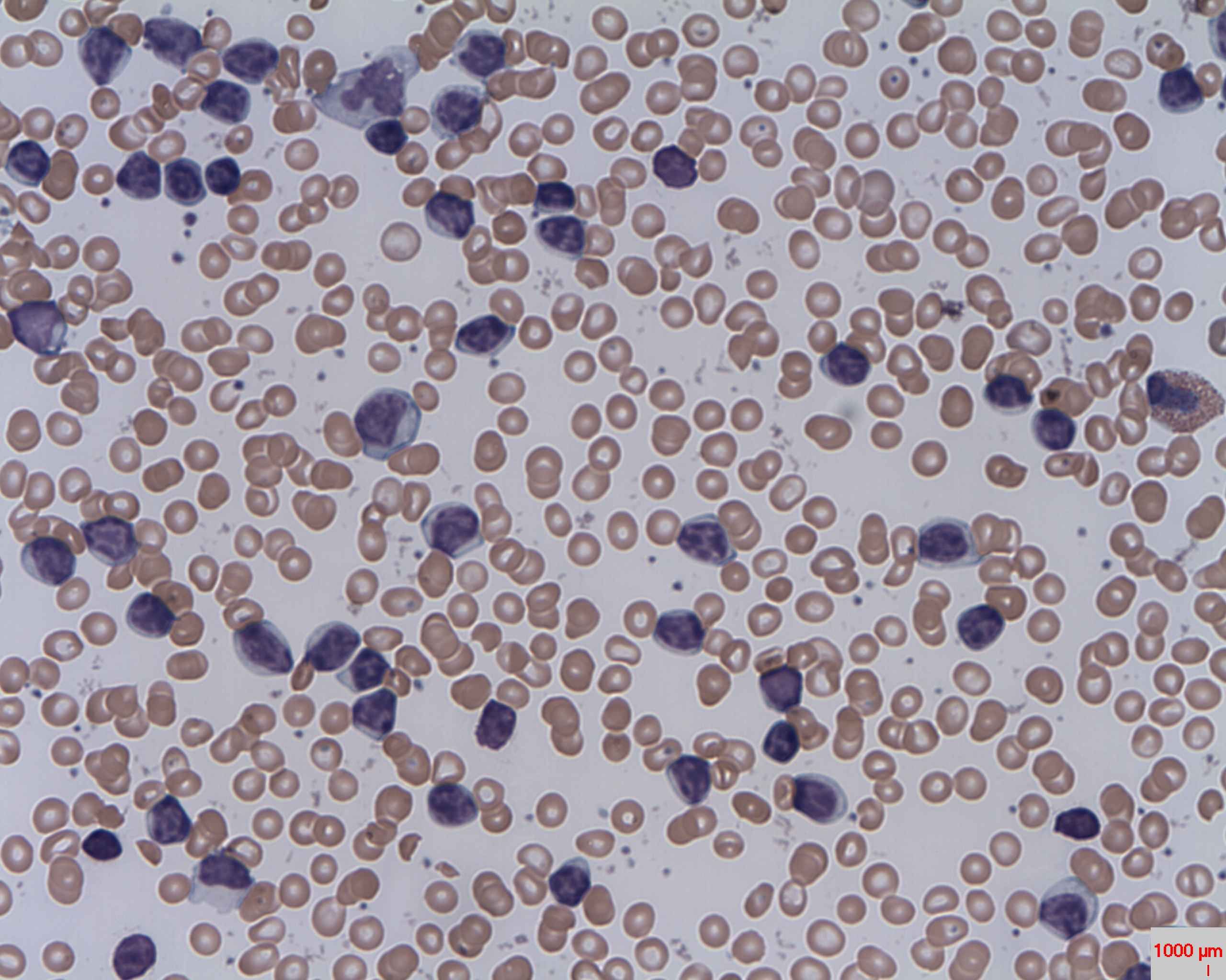 chronic lymphocytic leukemia (CLL)