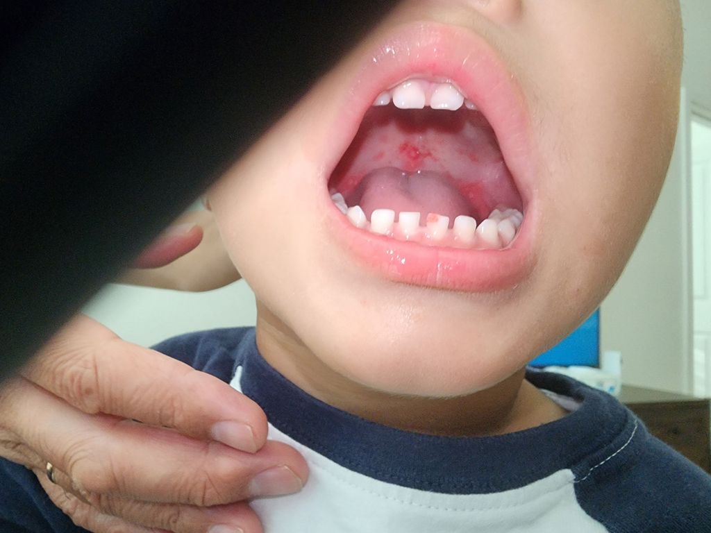 painful mouth lesions HFMD