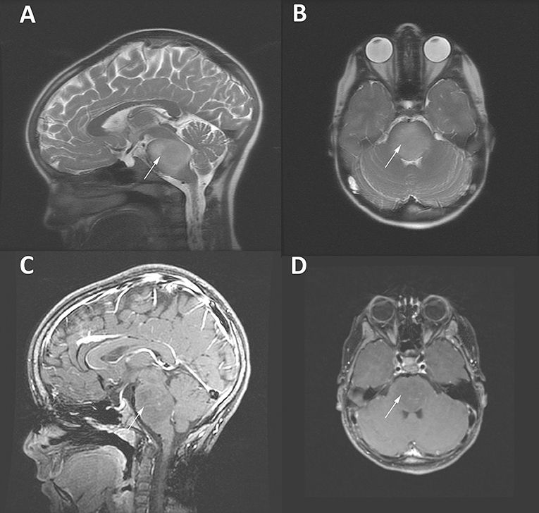 diffuse midline gliomas