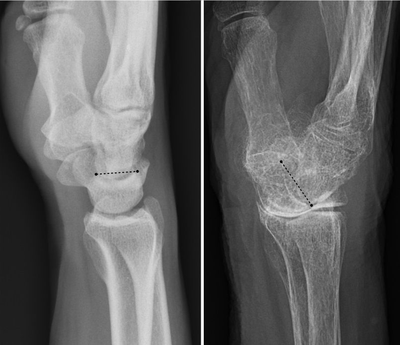 human wrist joint