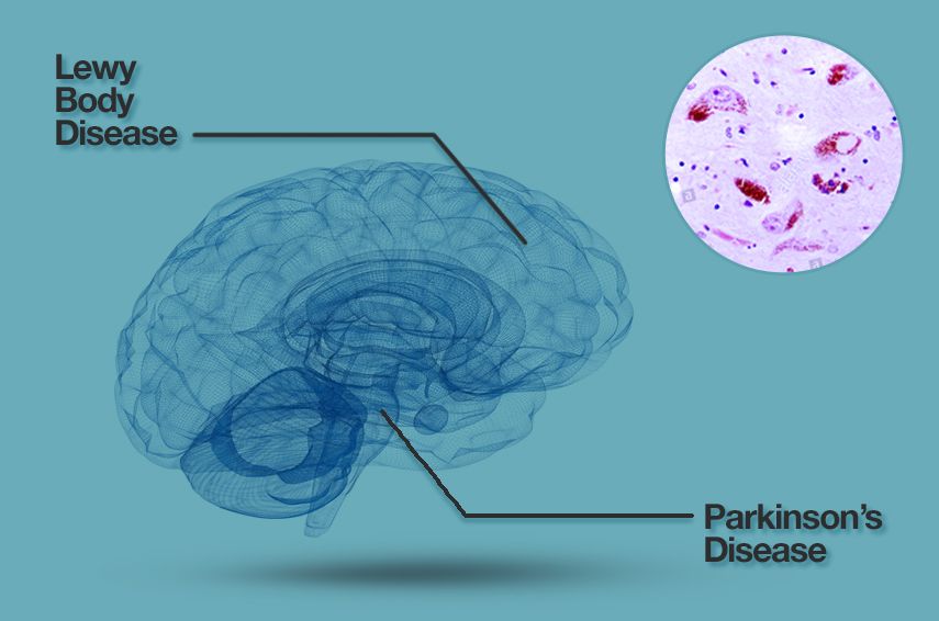 The Unseen Battle: Misdiagnosis and the Nature of Lewy Body Dementia