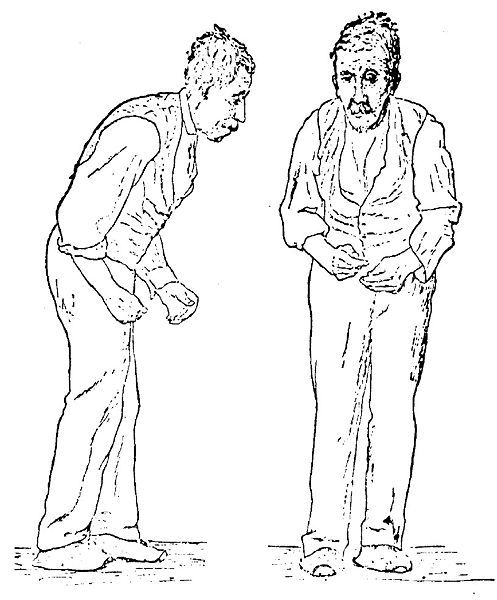 Parkinson's disease treatment