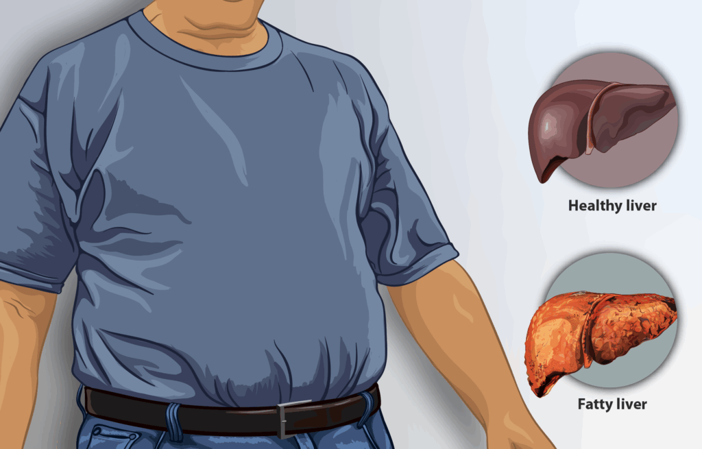 Beyond the Sweetener: New Research Uncovers the Alarming Link Between Diet Sodas, Sugary Drinks, and Rising Liver Disease