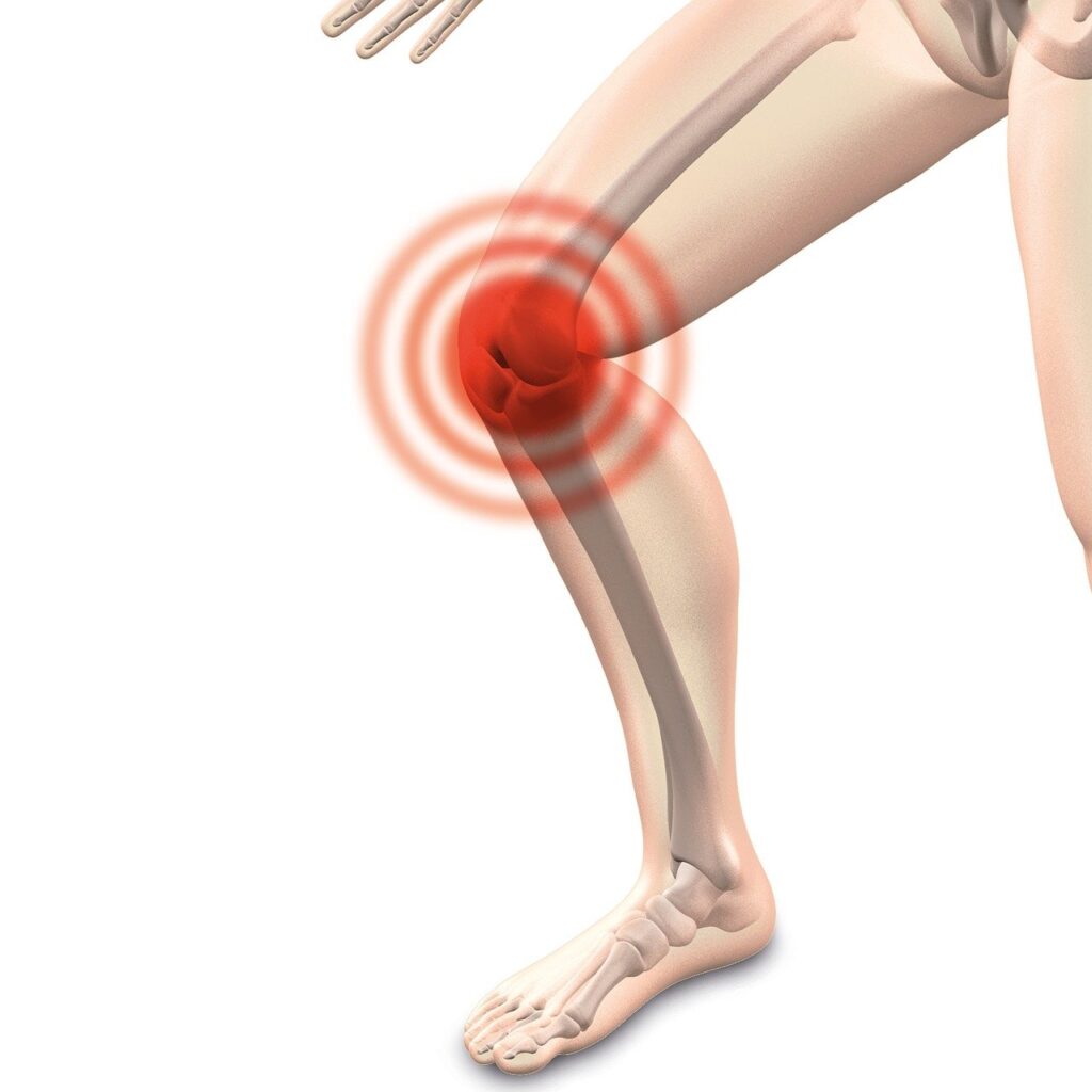 arthrocalman, osteoarthritis, knee, knee, knee, knee, knee, knee