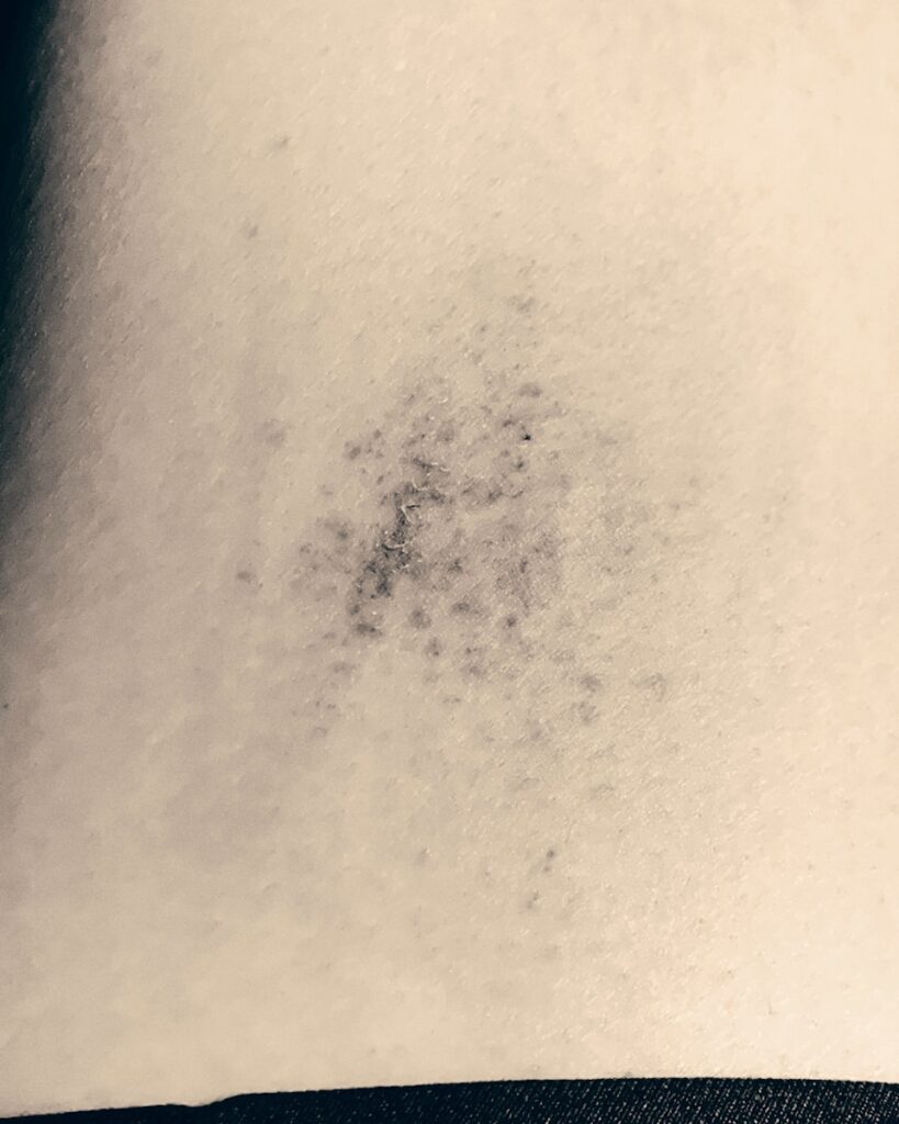 Beyond the Bruise: Essential Anemia Warning Signs Including Those That Start in Your Chest You Should Never Ignore.